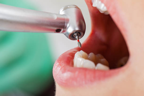 Best Lost Filling or Crown Replacement in Bridgman, MI